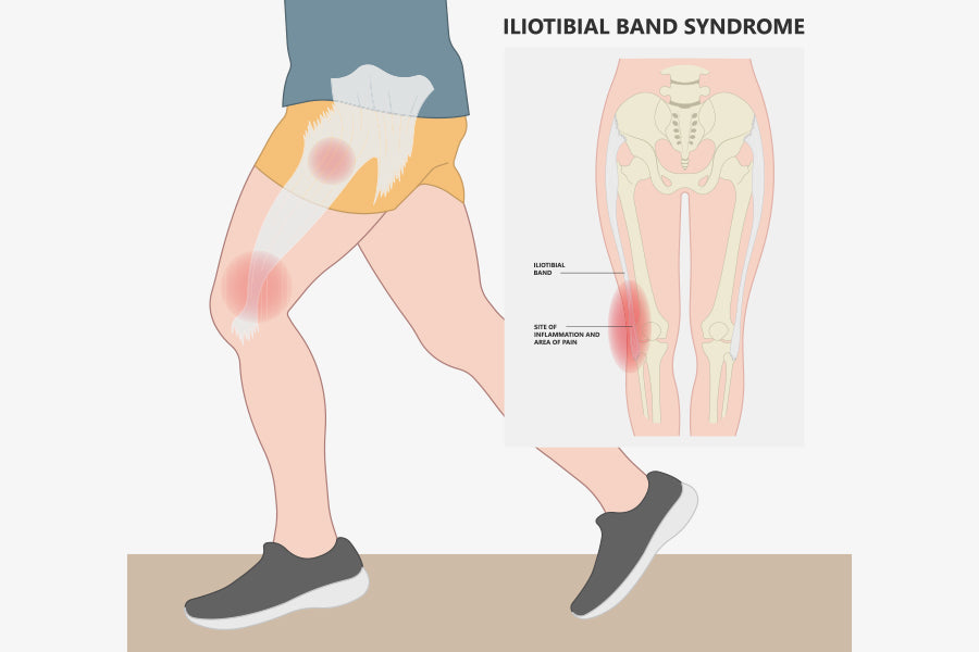 Exercise Program for IT Band Syndrome